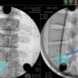 Endoscopic Spine Surgery