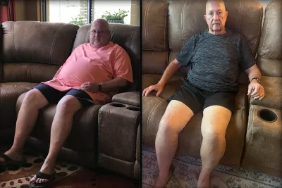 Jim’s Bariatric Surgery Journey