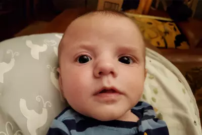 Mikey after Craniosynostosis Treatment
