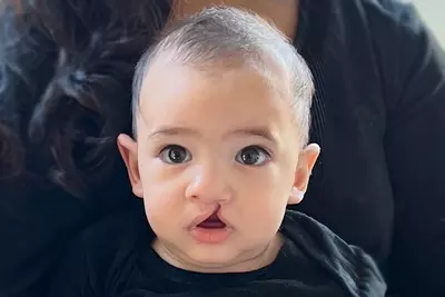 Piero Before cleft surgery