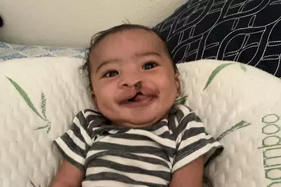 Romeo Before Cleft Lip Surgery