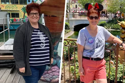 Sarah Before and After Bariatrics