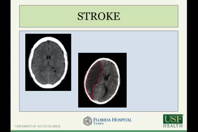 CME: Complex Stroke and Cerebrovascular Surgery - Raul Olivera, MD