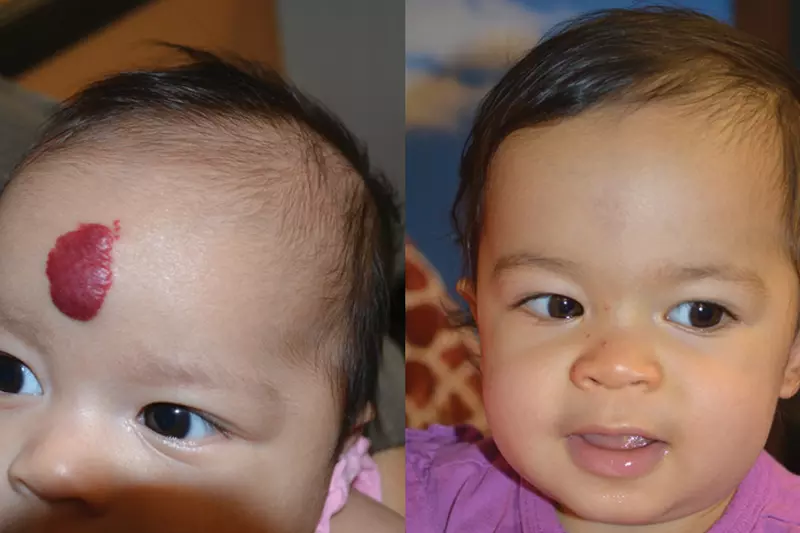 Before and After child with hemangioma 