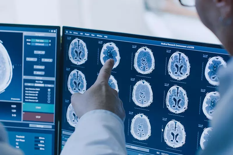 Doctors looking at a screen with brain scans