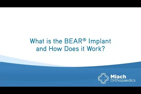 What is the BEAR Implant and How Does it Work? | Q&A | Dr. Sean Keyes | Miach Orthopaedics