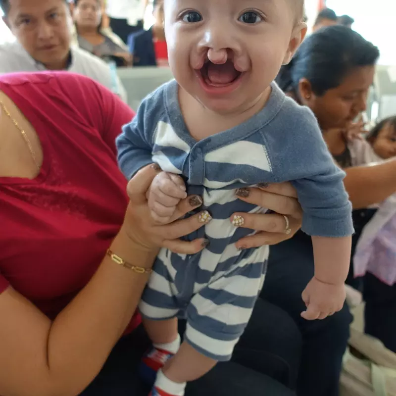 A baby born with Cleft Lip