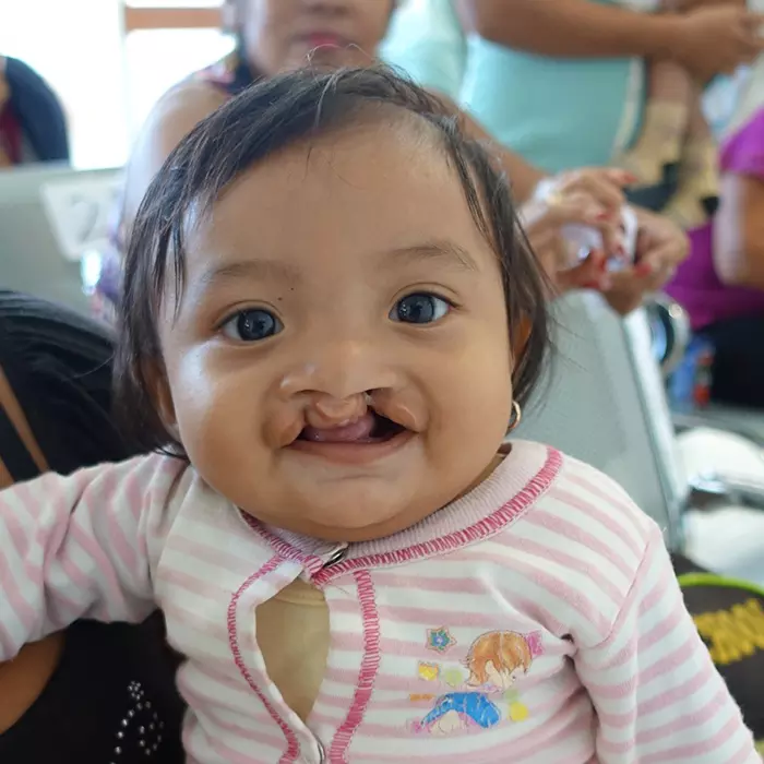 a baby with a cleft lip