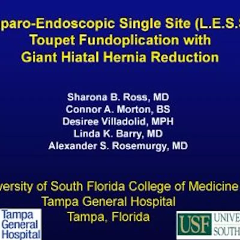 Laparo-Endoscopic Single Site (LESS) Toupet Fundoplication with Giant Hiatal Hernia Repair video thumbnail.