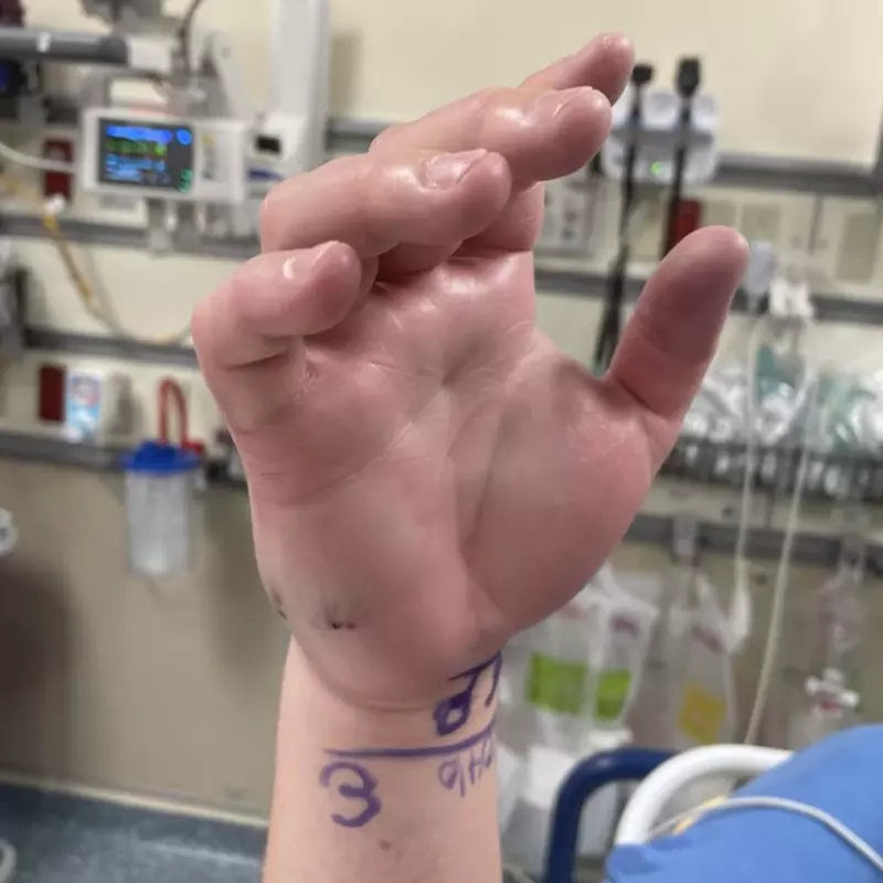 A water moccasin bit Marcus Engel's right hand.