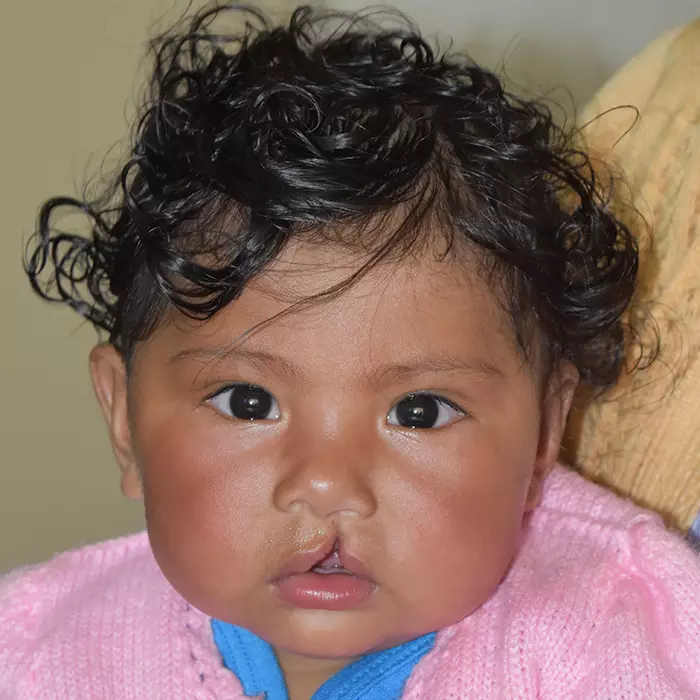 a baby with a cleft lip