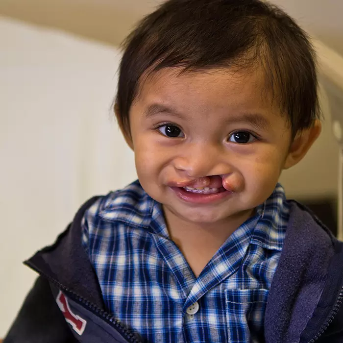a boy with a cleft lip