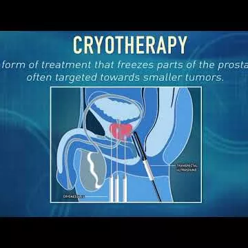 What is Cryotherapy? | Global Robotics Institute | AdventHealth