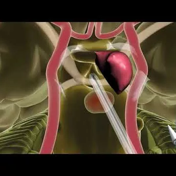 Endoscopic Endonasal Skull Base Surgery - Minimally Invasive Brain Surgery