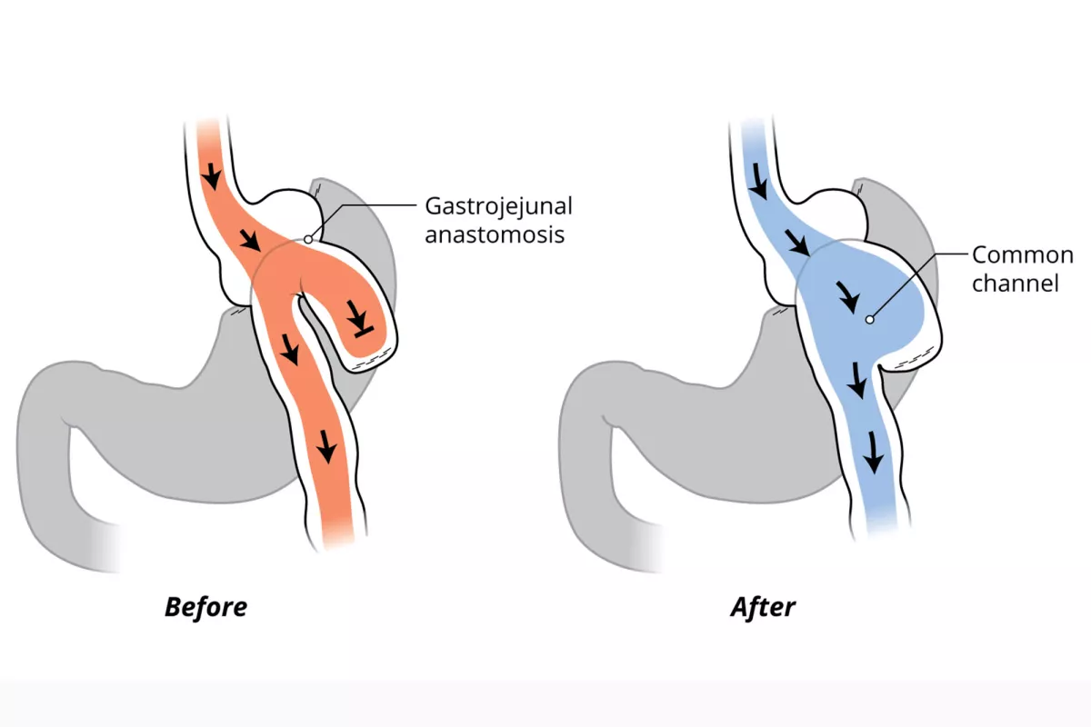 Before and after sketches of Candy Cane procedure