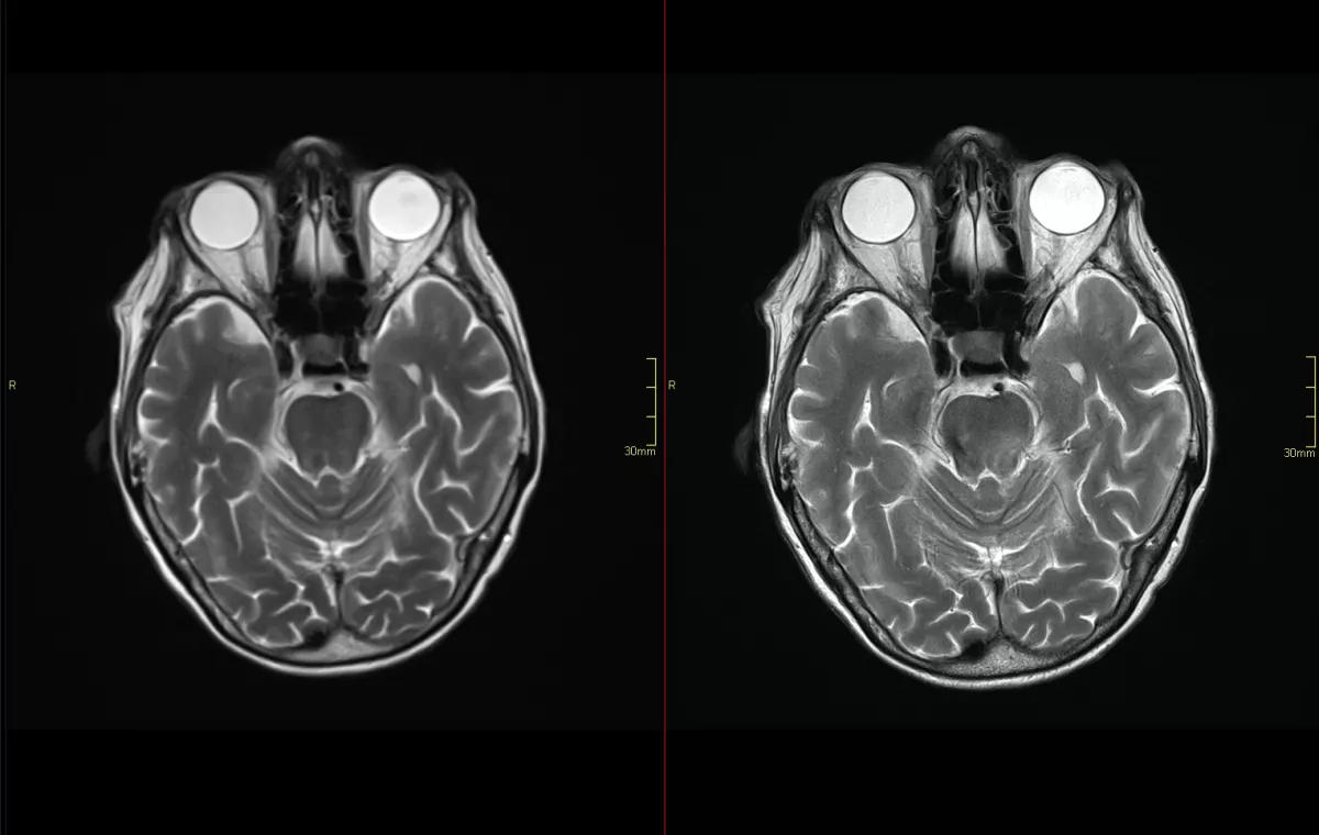 Brain MRI image: left side is regular MRI and right is AI MRI