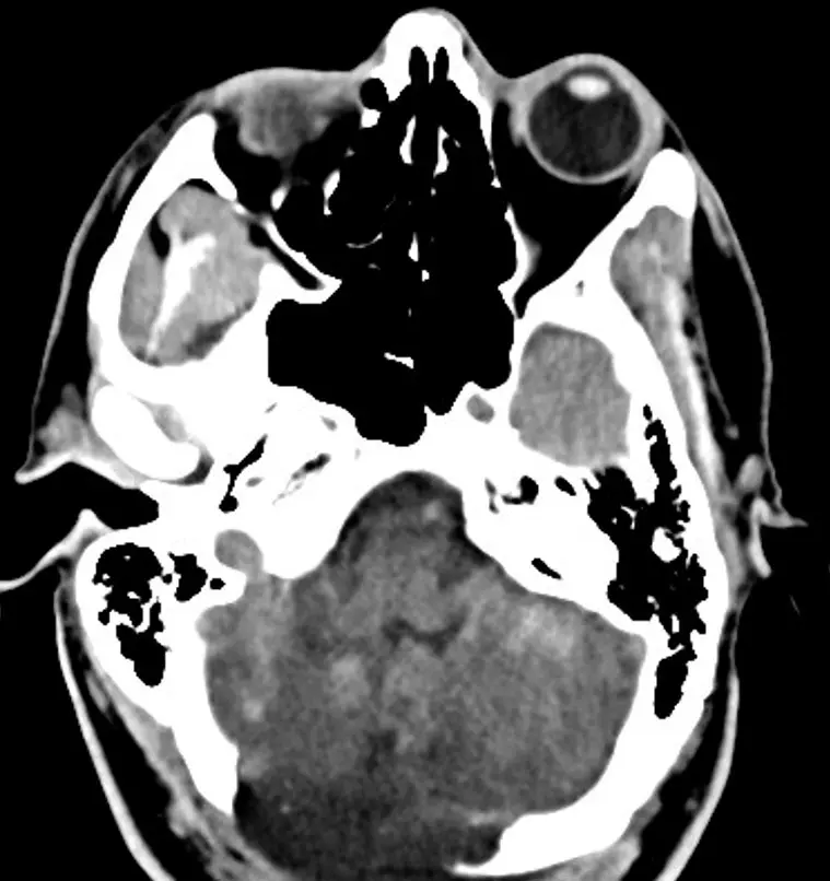 Follow-up CT with improvement of cerebellar edema  