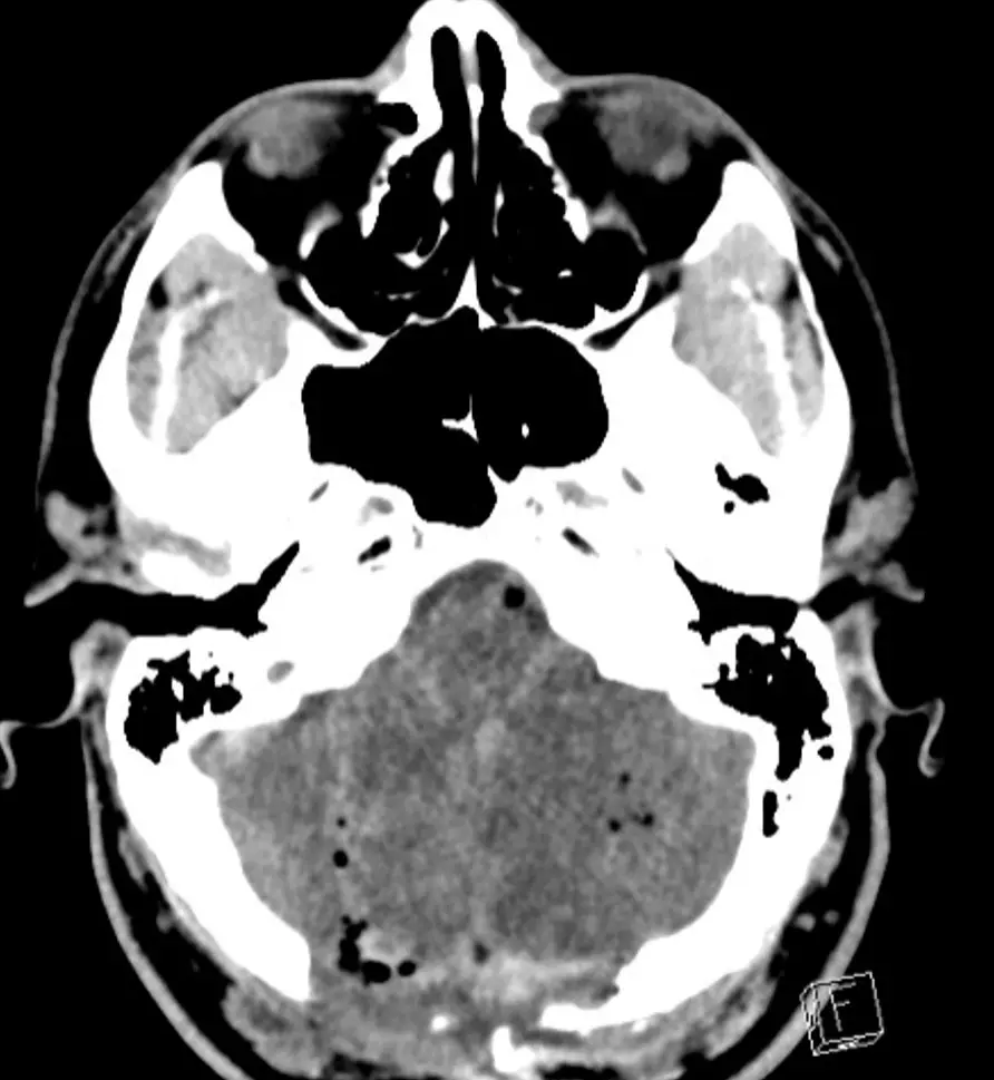 CT post suboccipital craniotomy  