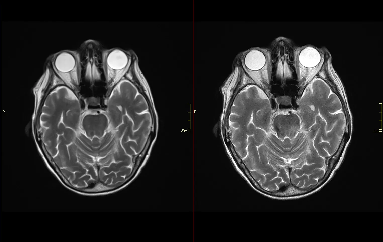 Brain MRI image: left side is regular MRI and right is AI MRI