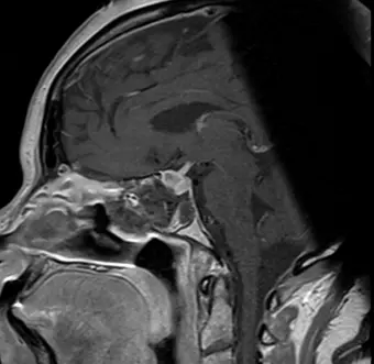 Post-Op Image of Pituitary Tumor 1