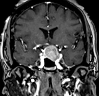 Pre-Op Pituitary Tumor Image 2