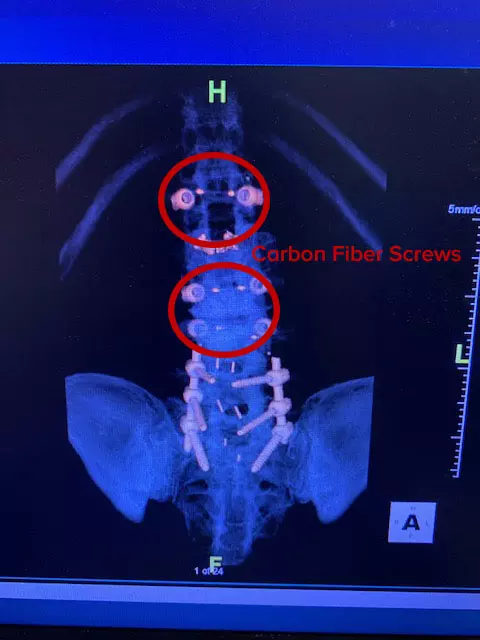 A circled indication of where the carbon screws are at in the x-ray