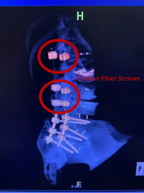 A circled indication of where the carbon screws are at in the x-ray